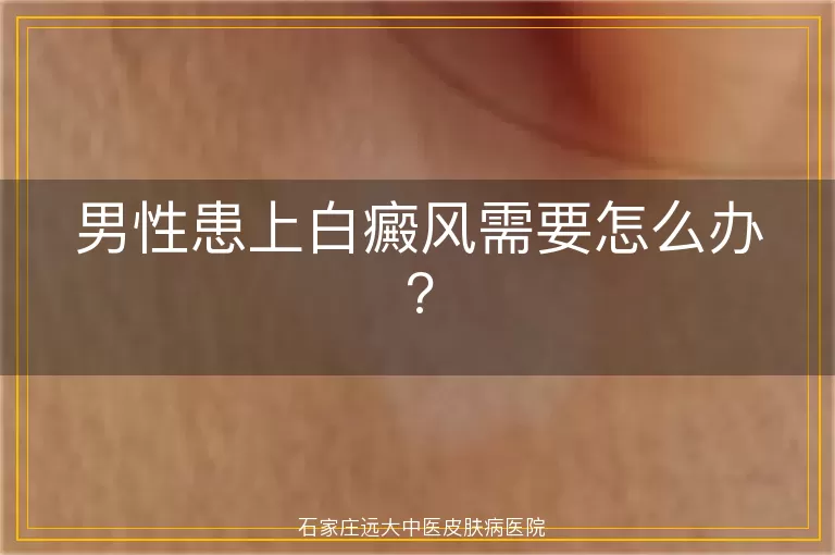 男性患上白癜风需要怎么办?