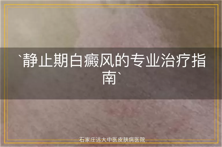 静止期白癜风的专业治疗指南