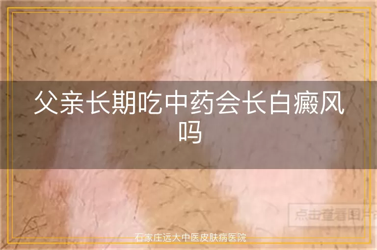 父亲长期吃中药会长白癜风吗
