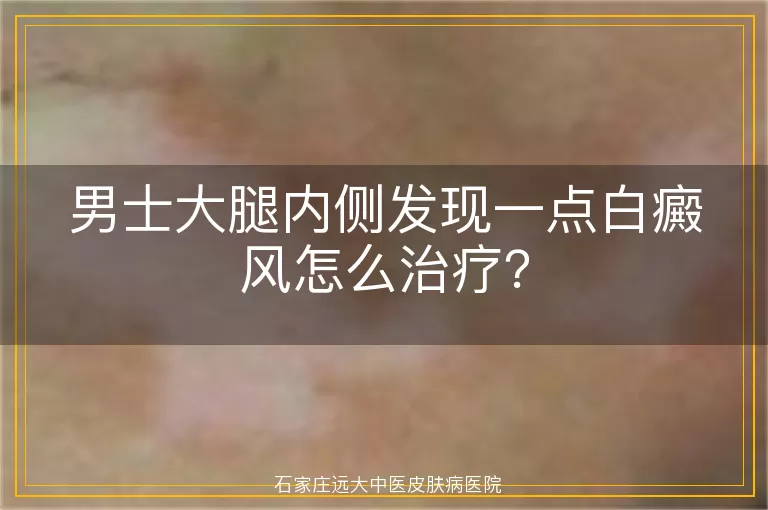 男士大腿内侧发现一点白癜风怎么治疗？