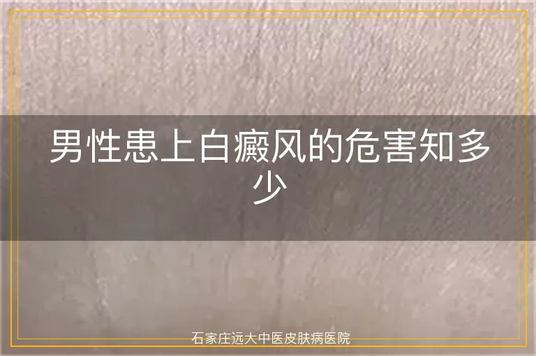 男性患上白癜风的危害知多少