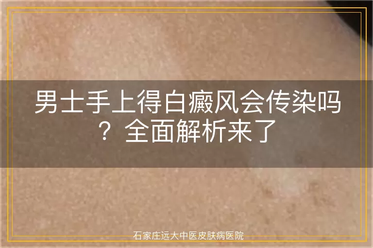 男士手上得白癜风会传染吗？全面解析来了