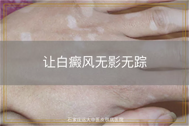 让白癜风无影无踪