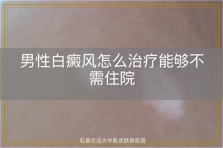 男性白癜风怎么治疗能够不需住院