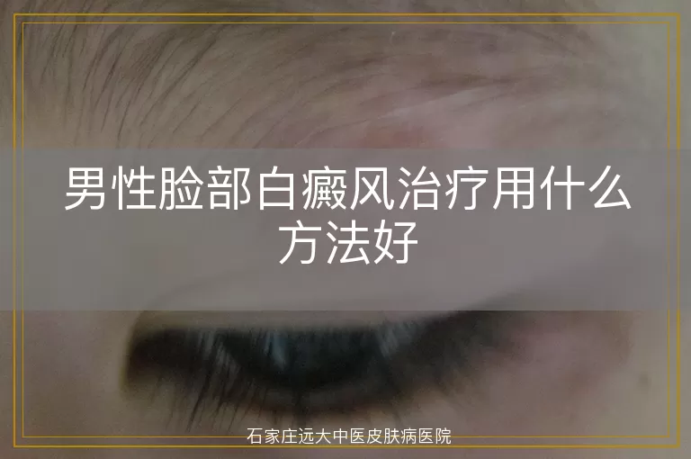 男性脸部白癜风治疗用什么方法好