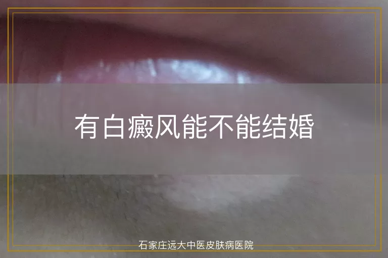 有白癜风能不能结婚