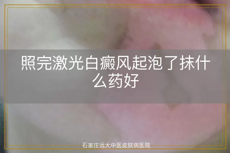 照完激光白癜风起泡了抹什么药好