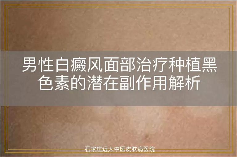 男性白癜风面部治疗种植黑色素的潜在副作用解析