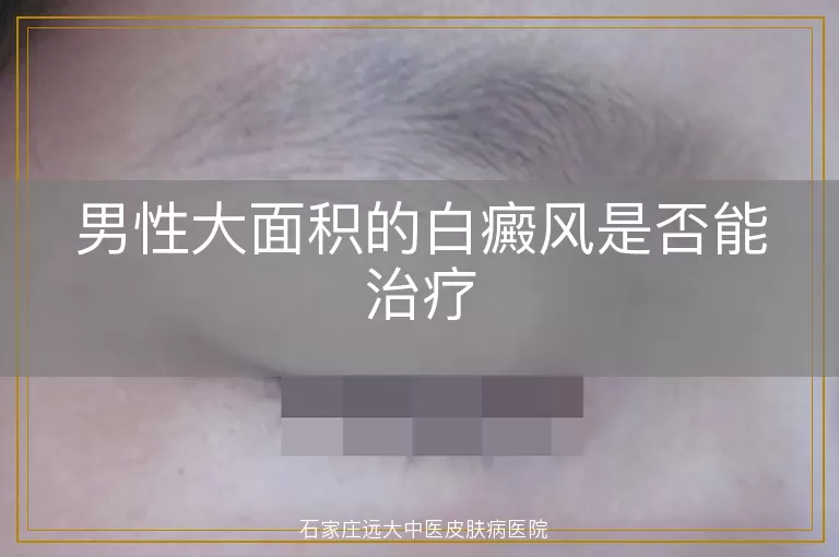男性大面积的白癜风是否能治疗