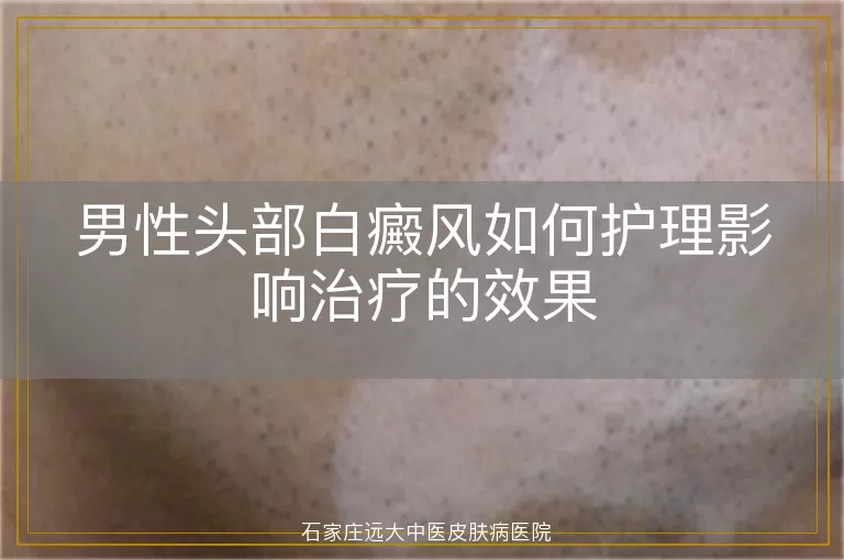 男性头部白癜风如何护理影响治疗的效果