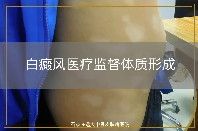 白癜风医疗监督体质形成
