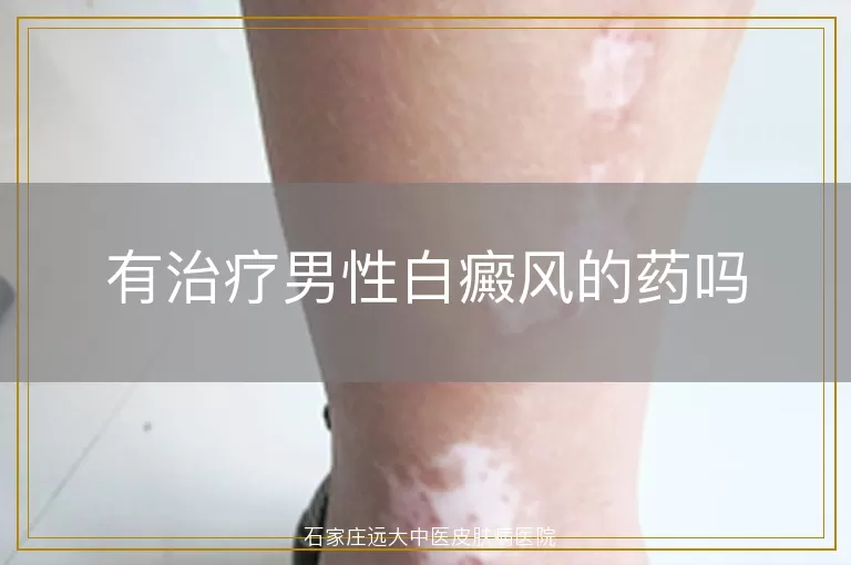 有治疗男性白癜风的药吗