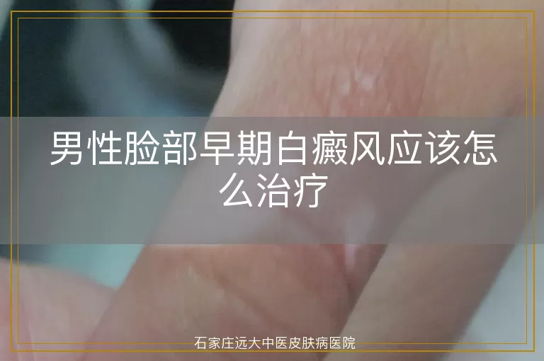 男性脸部早期白癜风应该怎么治疗