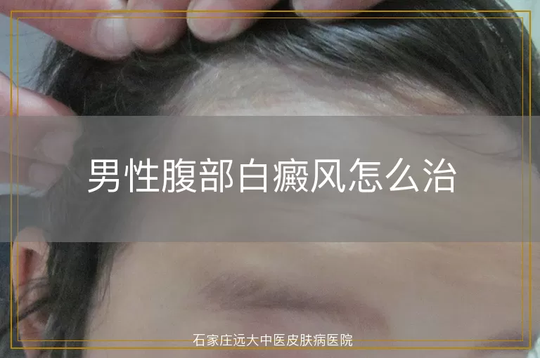 男性腹部白癜风怎么治