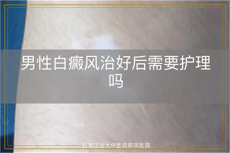 男性白癜风治好后需要护理吗