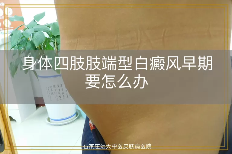 身体四肢肢端型白癜风早期要怎么办