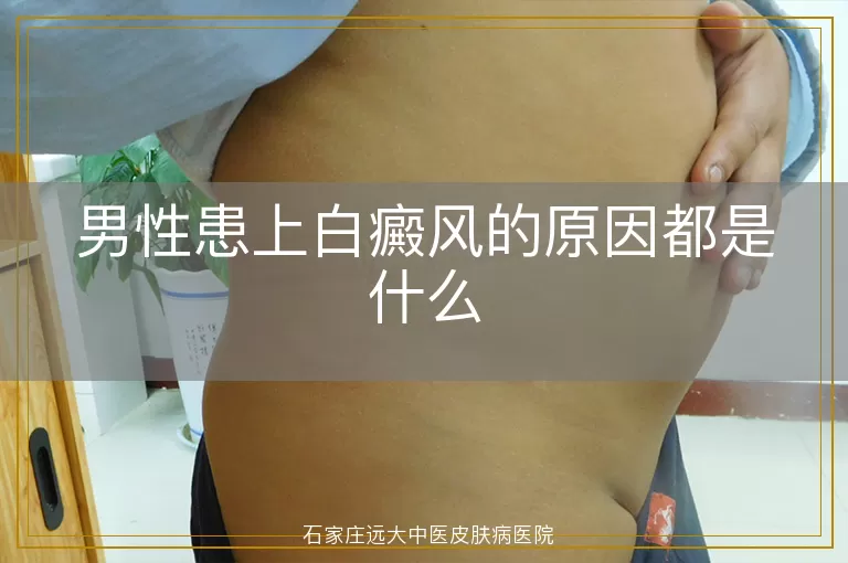 男性患上白癜风的原因都是什么