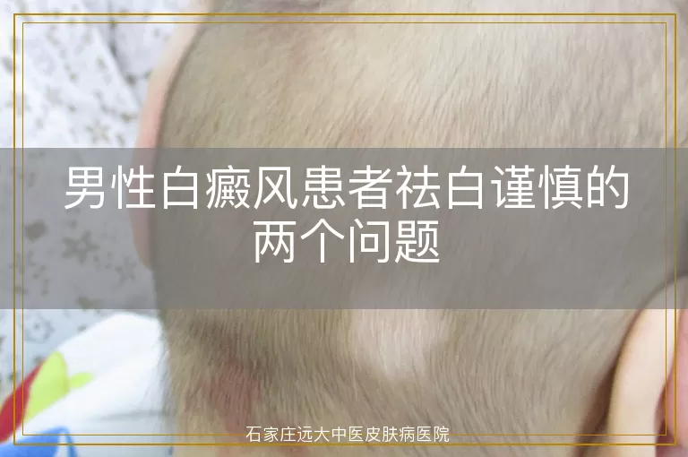 男性白癜风患者祛白谨慎的两个问题