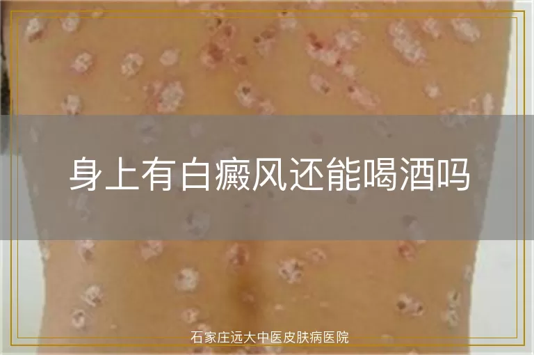 身上有白癜风还能喝酒吗