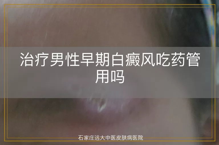 治疗男性早期白癜风吃药管用吗