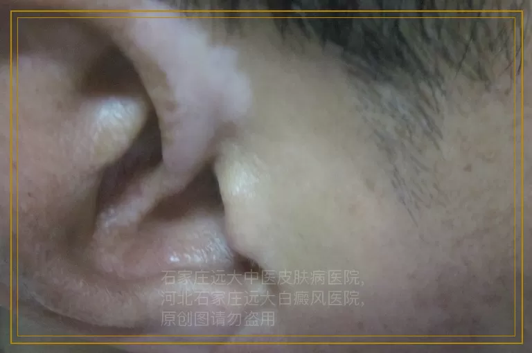白癜风巧食黑豆治体虚四例