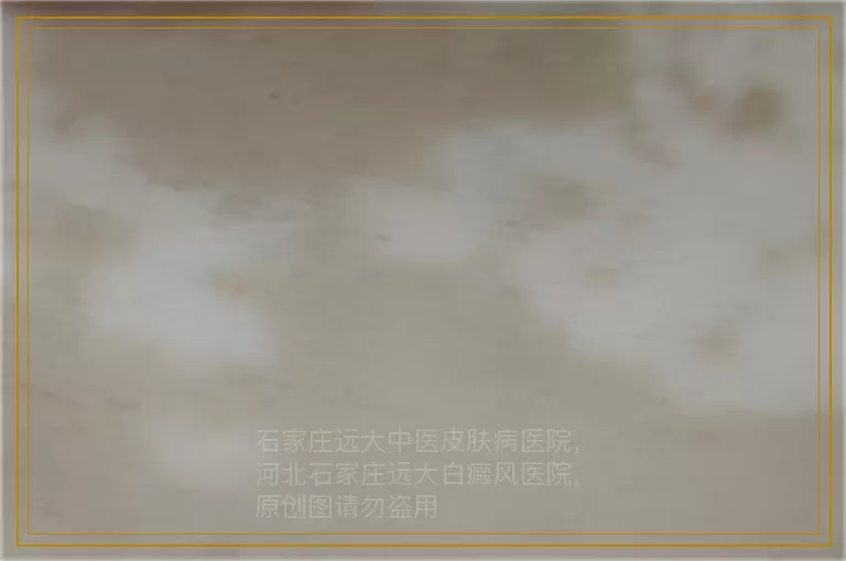 男生如果有白癜风会遗传给孩子吗