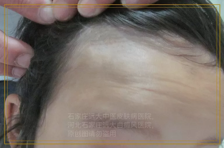 男人身上好多白点是什么病