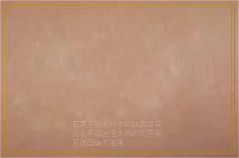 男性白癜风早期能治疗吗