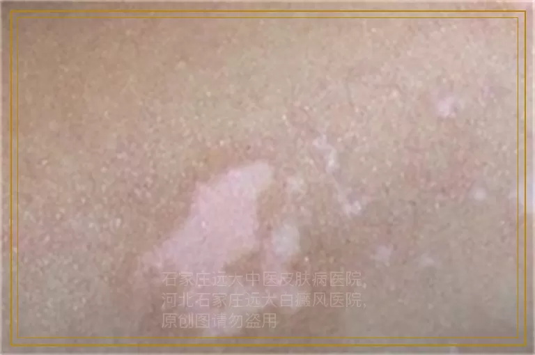 男性的白癜风要怎么治才能治好