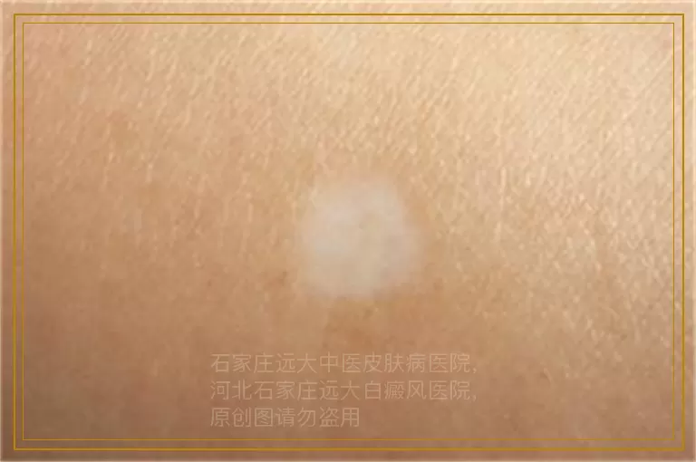 男性白癜风的治疗方法有哪些