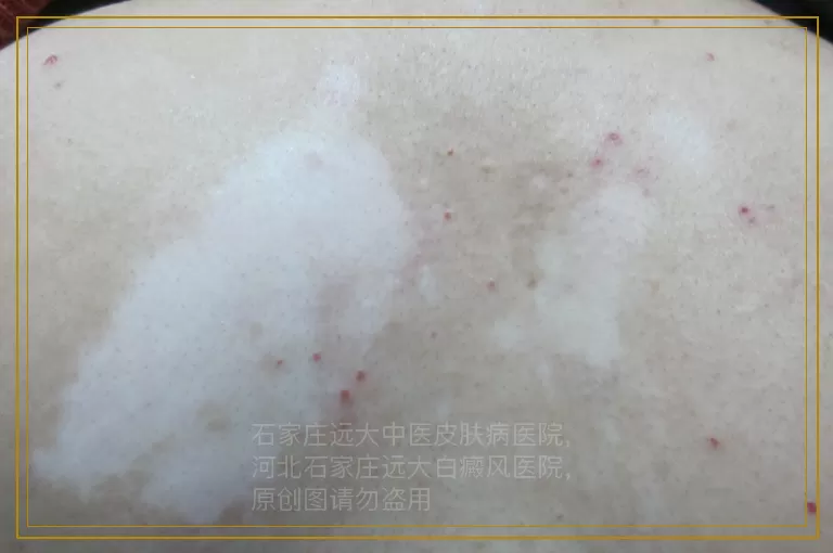 男性肛门变白怀疑是白癜风