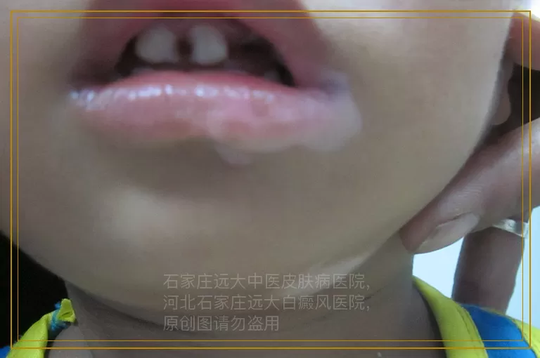 男士脖子和后背好多白斑