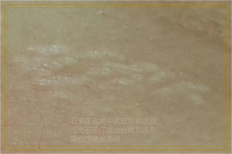 针对早期白癜风的治疗方法