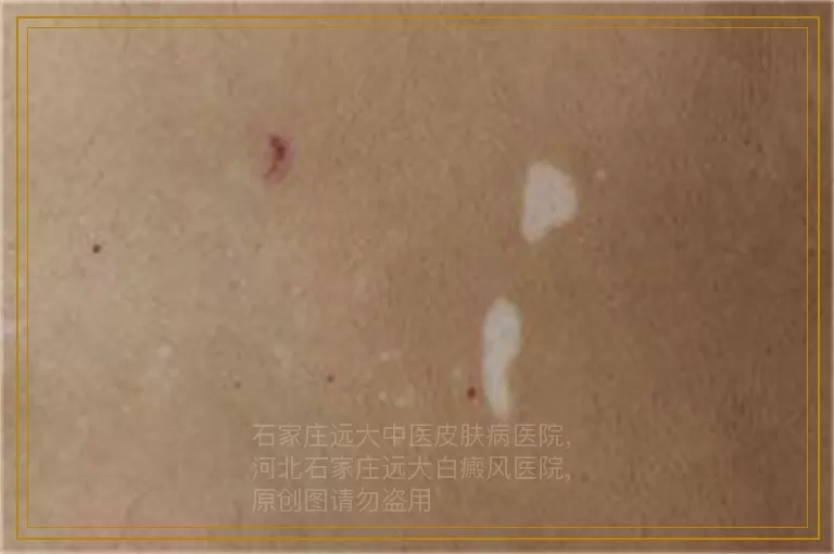 男人脸上有白癜风怎么治?