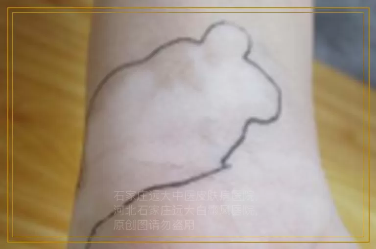 男生也有白癜风了是怎么回事