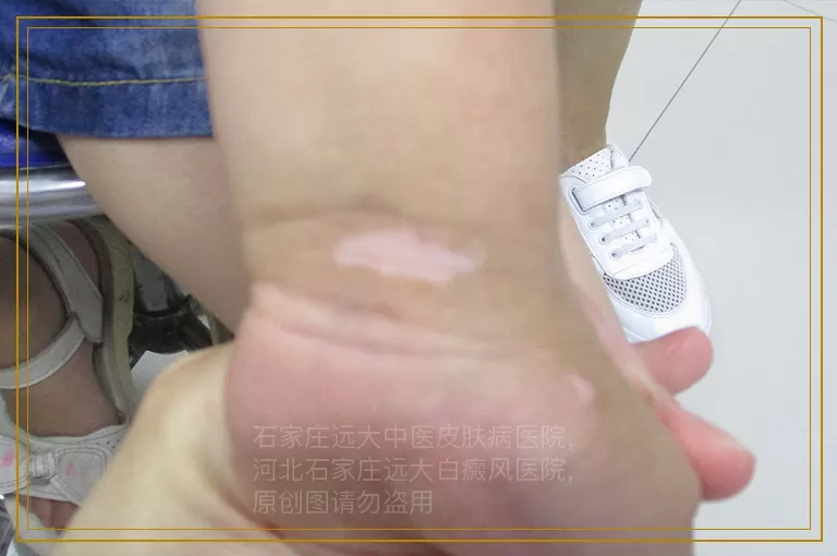 老公嘴角有白癜风怎么办?