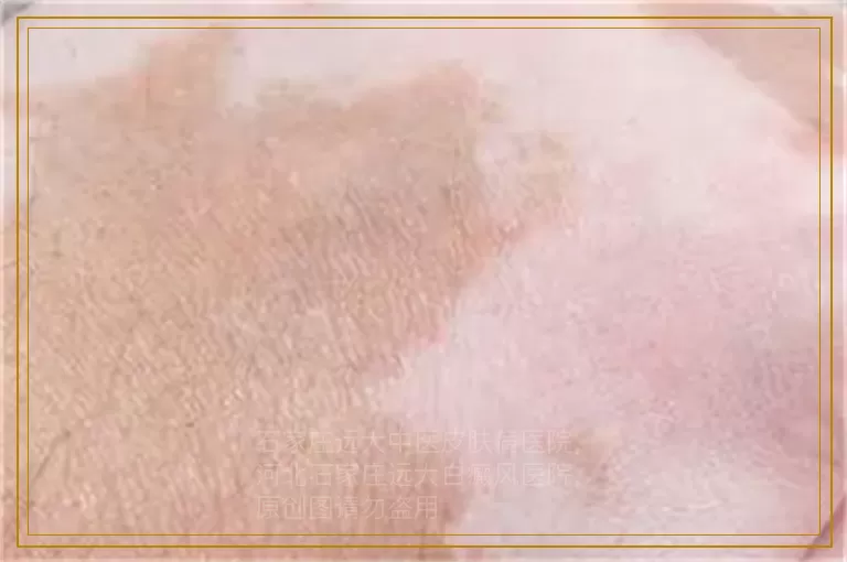 白癜风患者如何自我调节