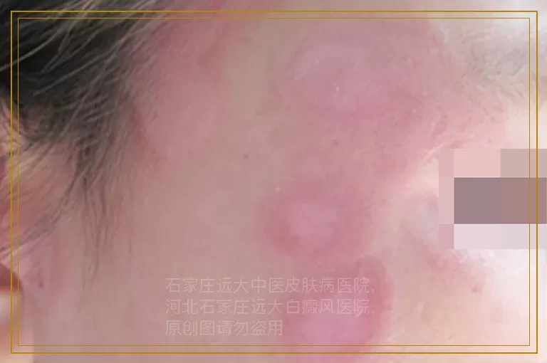 男性白癜风早期能治好吗