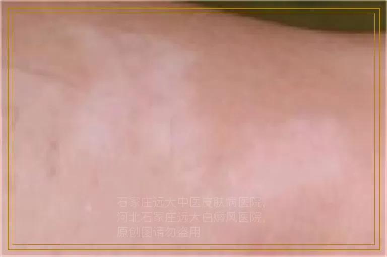 男性白癜风药物治疗很久不见效果咋回事