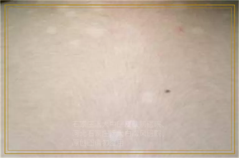 白癜风早期白斑的三个明显特征
