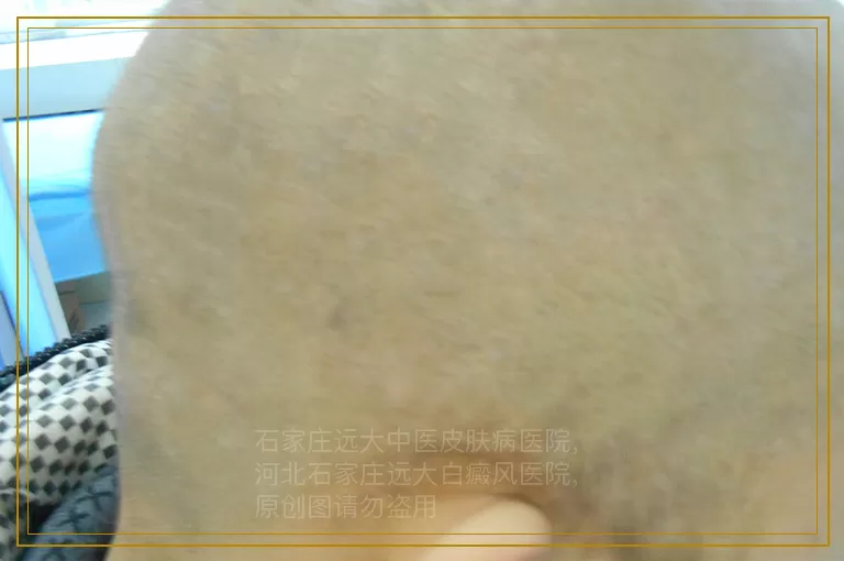 春夏季节是白癜风的高发病期