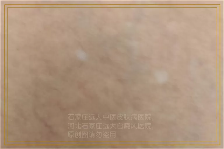 男生大腿根白癜风图片