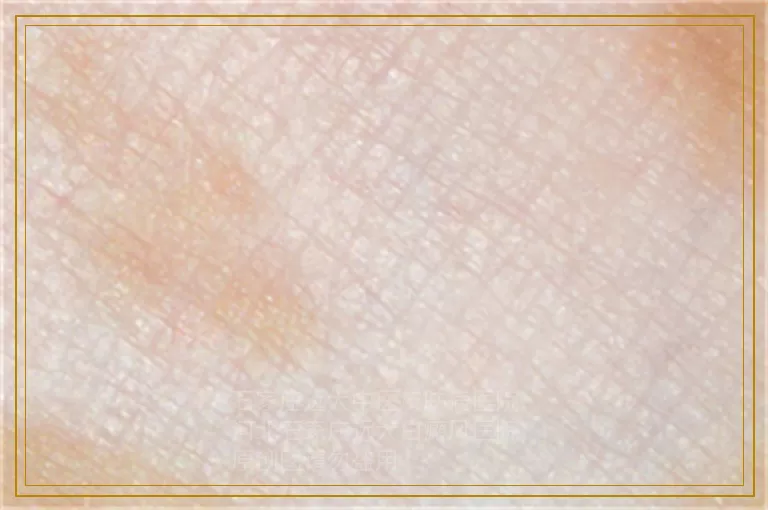 正确辨别白癜风