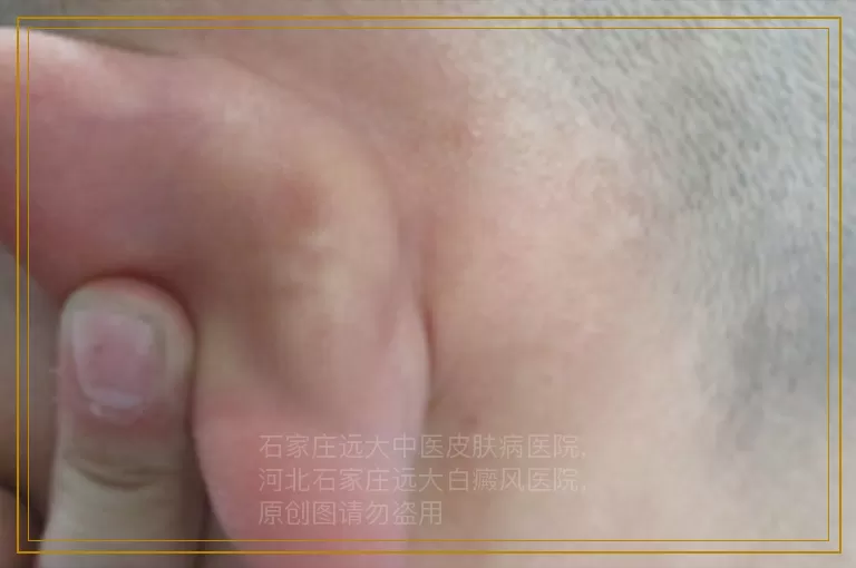 男孩子生殖器周围都是白癜风怎么治能好