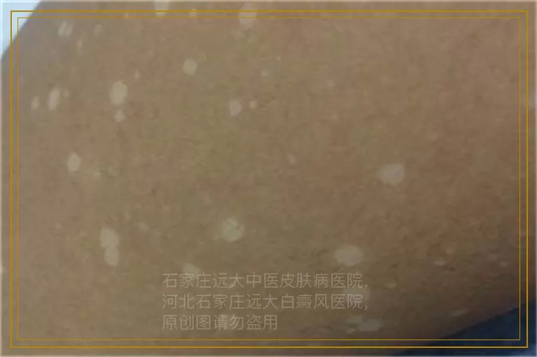 适宜使用白癜风光疗的患者