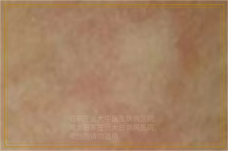 男性手背上好几个白点是什么