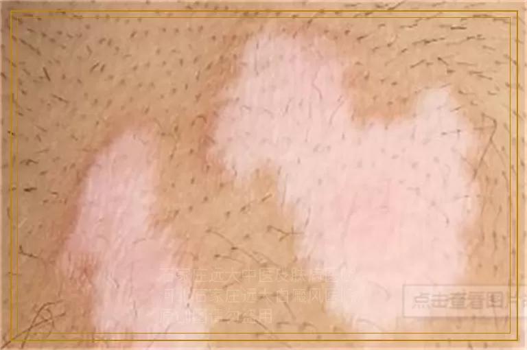 男性白癜风进展期可以光疗吗