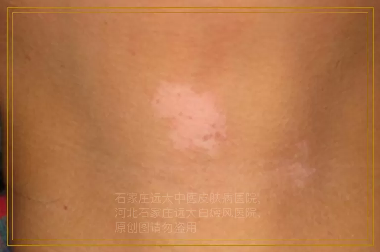 男性隐私部位白斑怎么治