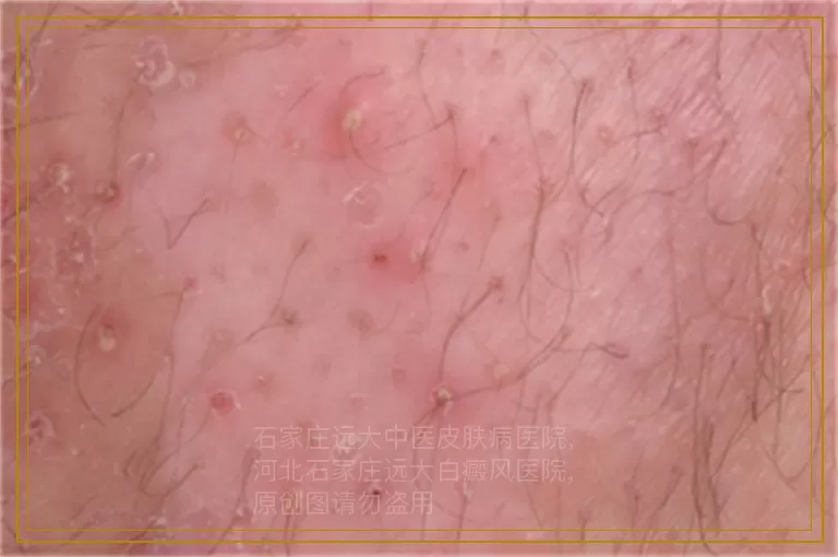 男性大腿内侧白斑图片