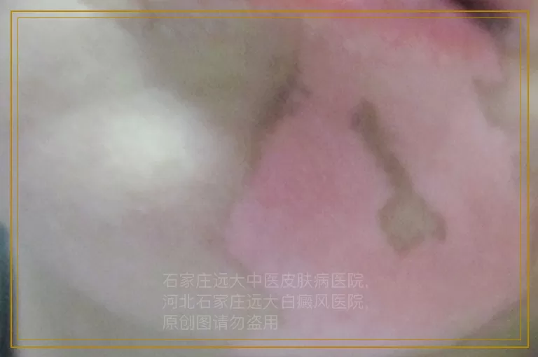 男人身上有白色的斑点是什么